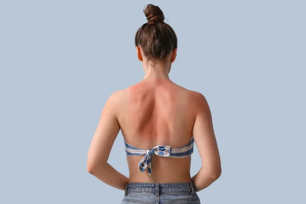 Αλλεργική Νεαρή Γυναίκα Ηλιοκαμένο Δέρμα Μπλε Φόντο Πίσω Όψη — Φωτογραφία Αρχείου
