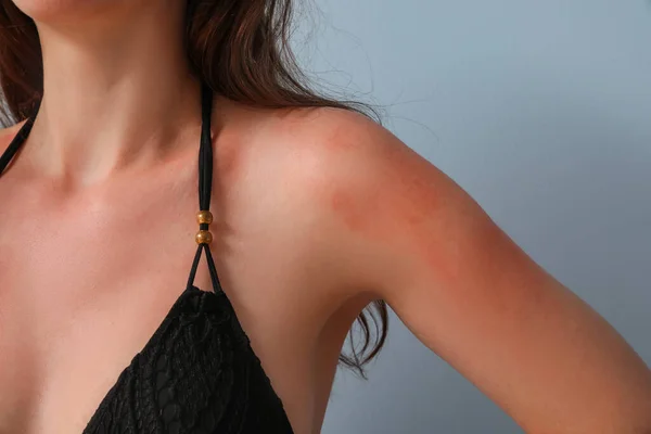 青い背景に日焼けした皮膚を持つアレルギーの若い女性 クローズアップ — ストック写真