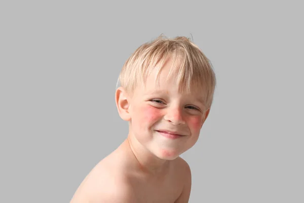 Аллергичный Маленький Мальчик Обгорелым Лицом Сером Фоне Крупным Планом — стоковое фото