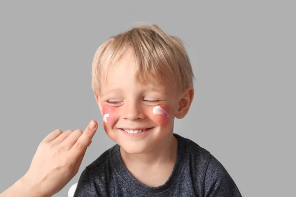 Mutter Cremt Das Gesicht Ihres Allergisch Reagierenden Kleinen Sohnes Auf — Stockfoto