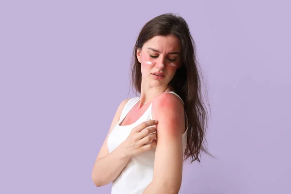 Αλλεργική Νεαρή Γυναίκα Ηλιοκαμένο Δέρμα Και Κρέμα Λιλά Φόντο — Φωτογραφία Αρχείου