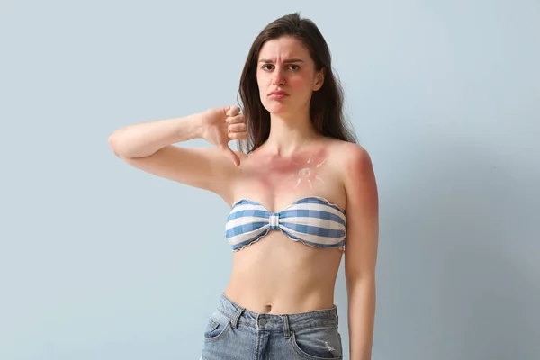 日焼けした肌と青い背景に親指ダウンを示すクリームで作られた太陽を持つアレルギーの若い女性 — ストック写真