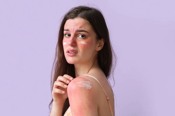 Αλλεργική Νεαρή Γυναίκα Ηλιοκαμένο Δέρμα Και Κρέμα Λιλά Φόντο Κοντινό — Φωτογραφία Αρχείου