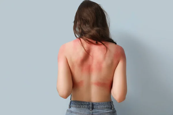 青い背景に日焼けした皮膚を持つアレルギーの若い女性 バックビュー — ストック写真