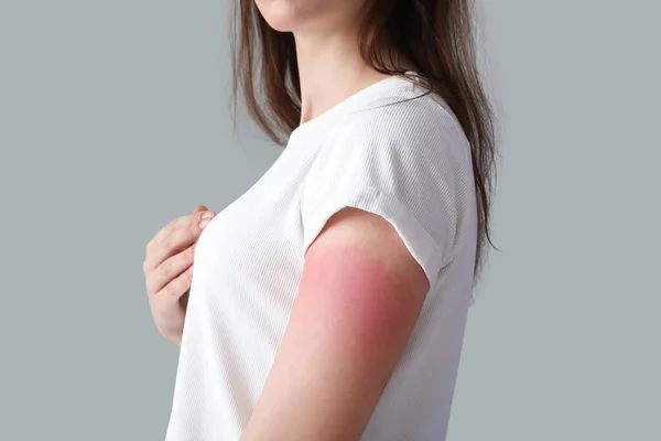 Αλλεργική Νεαρή Γυναίκα Ηλιοκαμένο Δέρμα Γκρι Φόντο Κοντινό Πλάνο — Φωτογραφία Αρχείου