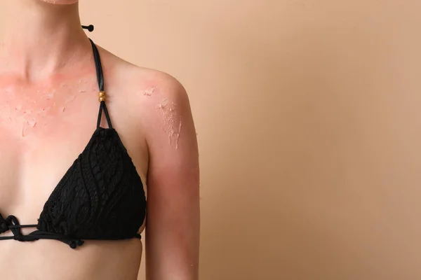 Αλλεργική Νεαρή Γυναίκα Ηλιοκαμένο Δέρμα Μπεζ Φόντο Κοντινό Πλάνο — Φωτογραφία Αρχείου