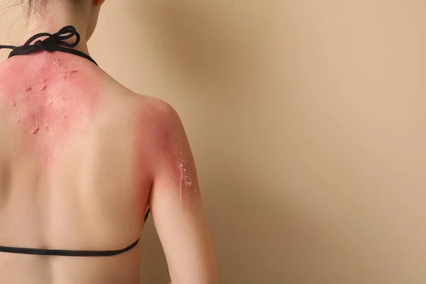 ベージュの背景に日焼けした肌を持つアレルギーの若い女性 バックビュー — ストック写真