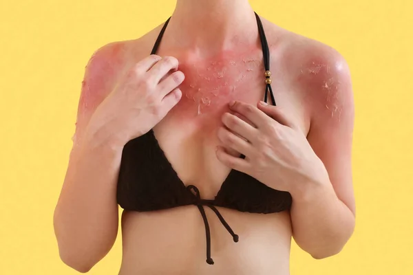 黄色の背景に日焼けした皮膚を持つアレルギーの若い女性 — ストック写真