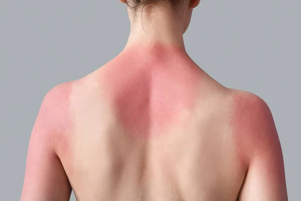 灰色の背景に日焼けした皮膚を持つアレルギーの若い女性 バックビュー — ストック写真
