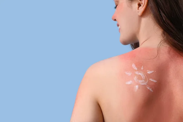 青い背景にクリームで作られた日焼けした肌と太陽を持つアレルギーの若い女性 バックビュー — ストック写真
