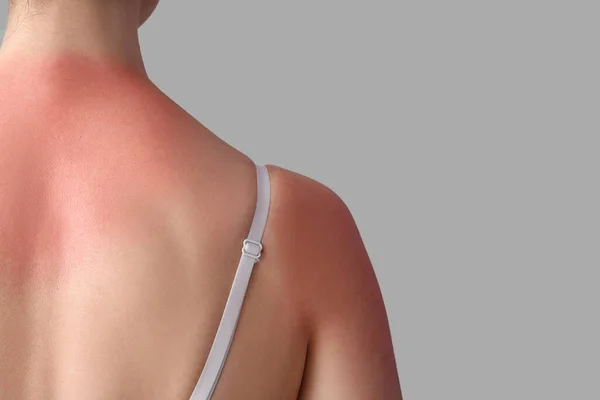 Αλλεργική Νεαρή Γυναίκα Ηλιοκαμένο Δέρμα Γκρι Φόντο Πίσω Όψη — Φωτογραφία Αρχείου