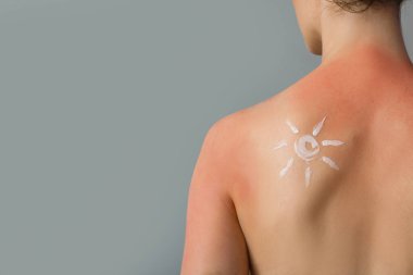 Güneş yanığı tenli, gri arka planda kremden yapılmış alerjisi olan genç bir kadın.