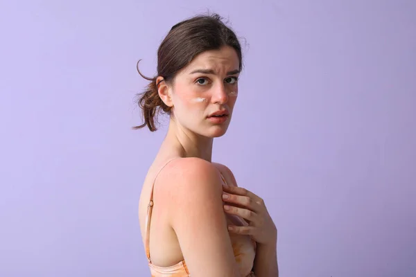 过敏的年轻女子 皮肤晒黑 背景紫丁香 特写镜头 — 图库照片