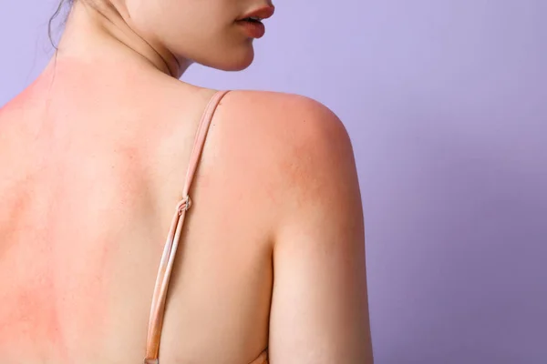 ライラックの背景に日焼けした肌を持つアレルギーの若い女性 バックビュー — ストック写真