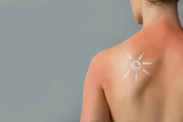 Αλλεργική Νεαρή Γυναίκα Ηλιοκαμένο Δέρμα Και Ήλιο Από Κρέμα Γκρι — Φωτογραφία Αρχείου