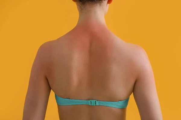 Allergic Young Woman Sunburned Skin Yellow Background Back View — Stock Photo, Image