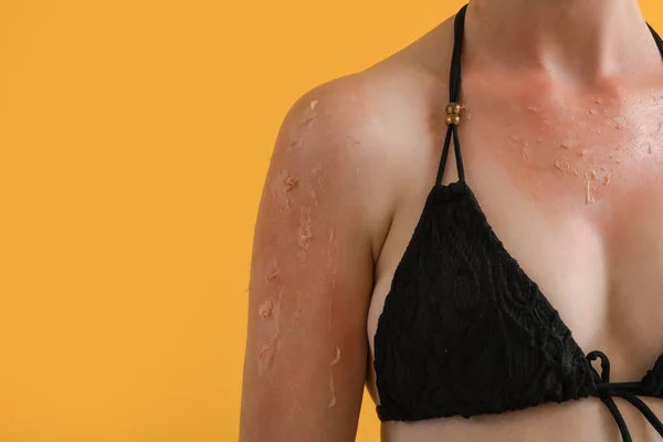Αλλεργική Νεαρή Γυναίκα Ηλιοκαμένο Δέρμα Κίτρινο Φόντο — Φωτογραφία Αρχείου