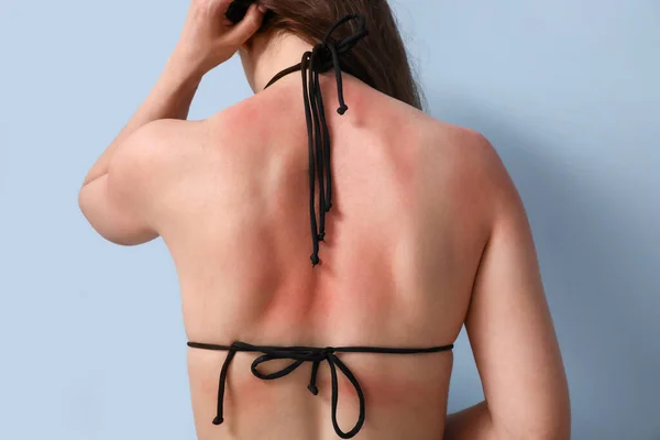 Αλλεργική Νεαρή Γυναίκα Ηλιοκαμένο Δέρμα Μπλε Φόντο Πίσω Όψη — Φωτογραφία Αρχείου