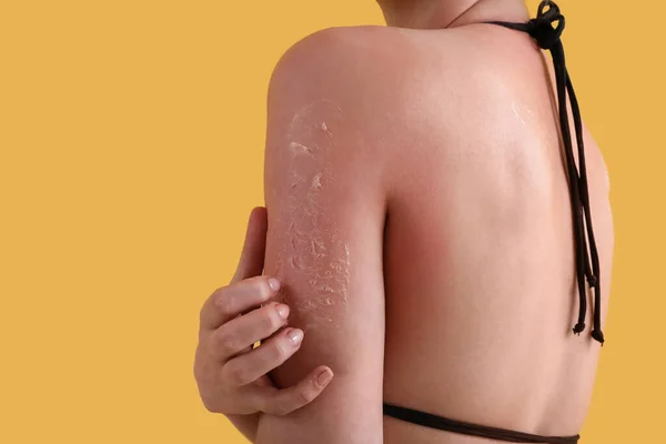 Allergische Jonge Vrouw Met Verbrande Huid Gele Achtergrond — Stockfoto