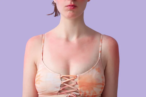 Αλλεργική Νεαρή Γυναίκα Ηλιοκαμένο Δέρμα Λιλά Φόντο Κοντινό Πλάνο — Φωτογραφία Αρχείου