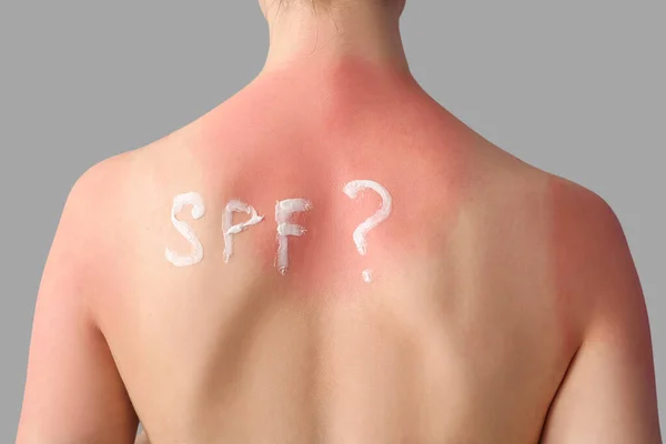 日焼けした肌と質問Spfとアレルギーの若い女性 灰色の背景には — ストック写真
