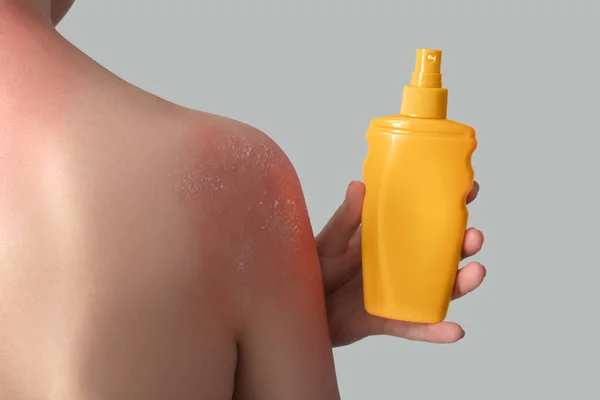 Αλλεργική Νεαρή Γυναίκα Ηλιοκαμένο Δέρμα Και Κρέμα Γκρι Φόντο Πίσω — Φωτογραφία Αρχείου