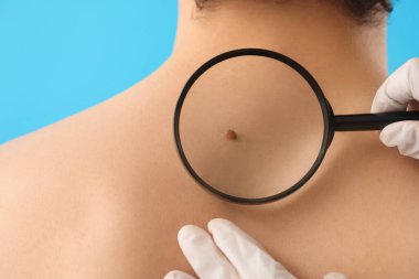 Dermatolog, genç adamın sırtındaki beni mavi arka planda büyüteçle inceliyor.