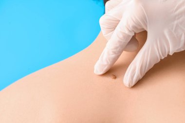 Dermatolog, genç adamın sırtındaki beni mavi arka planda inceliyor.