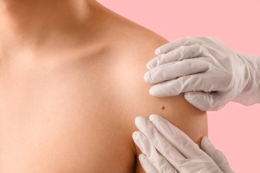Dermatolojist, genç adamın omzundaki benle pembe arka planı karşılaştırıyor. Yakın plan.