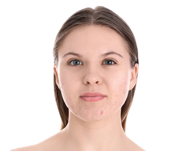 Teenager Mädchen Mit Akne Problem Auf Weißem Hintergrund Nahaufnahme — Stockfoto