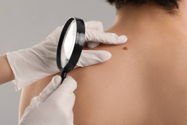 Dermatolog, genç adamın sırtındaki beni gri arka planda büyüteçle inceliyor.