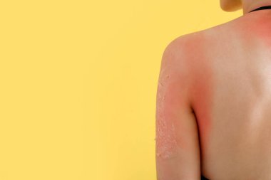 Sarı arka planda güneş yanığı olan alerjisi olan genç bir kadın.