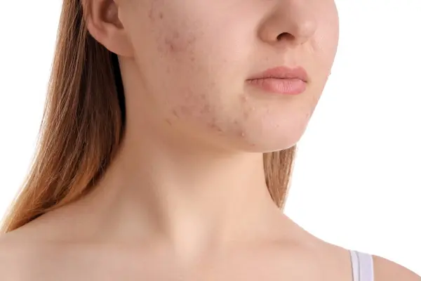 Teenage Girl Acne Problem White Background Closeup — Stock Photo, Image