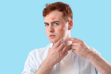 Mavi arka planda sivilceleri olan genç bir çocuk.