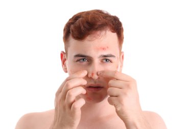 Beyaz arka planda sivilceleri olan genç bir çocuk.