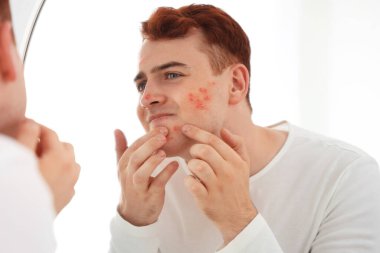 Banyoda sivilceleri olan genç bir çocuk.