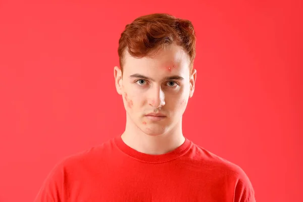 Teenager Junge Mit Akne Auf Rotem Hintergrund — Stockfoto