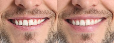 Dudak büyütme ameliyatından önce ve sonra genç adam, yakın plan.