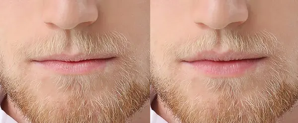 Young Man Lip Enhancement Closeup — Stock Photo, Image