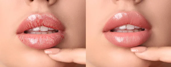 Junge Frau Vor Und Nach Der Behandlung Trockener Lippen Nahaufnahme — Stockfoto
