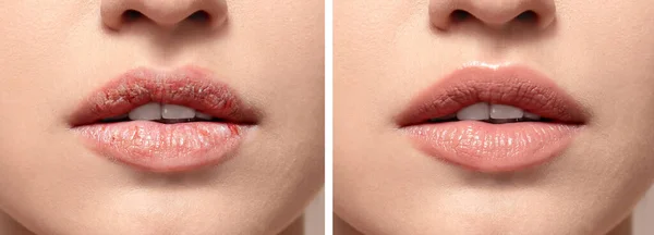 Young woman before and after treatment of dry lips, closeup