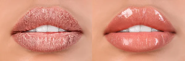 Young Woman Treatment Dry Lips Closeup — Stock Photo, Image