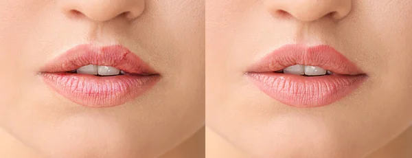 Junge Frau Vor Und Nach Der Behandlung Trockener Lippen Nahaufnahme — Stockfoto