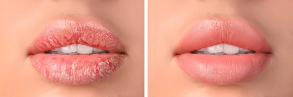 Jonge Vrouw Voor Behandeling Van Droge Lippen Close — Stockfoto