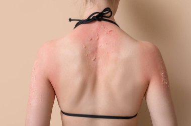 Bej arka planda güneş yanığı olan alerjisi olan genç bir kadın.