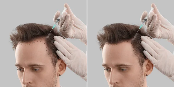 Young man before and after injections for hair loss treatment on grey background