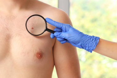Klinikte genç adamın göğsündeki beni büyüteçle inceleyen dermatolog.
