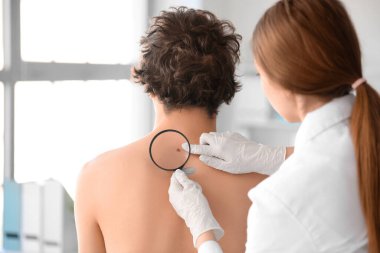 Dermatolog, klinikte büyüteçle genç adamın sırtındaki beni inceliyor.