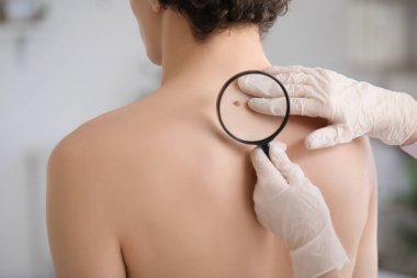 Dermatolog, klinikte büyüteçle genç adamın sırtındaki beni inceliyor.