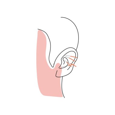 Ear of person undergoing acupuncture on white background